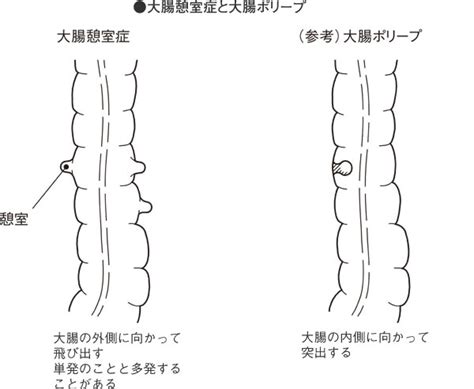 結の穴|大腸憩室症 (だいちょうけいしつしょう)とは 